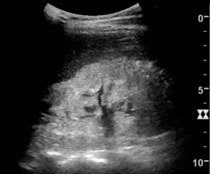 File:Ultrasonography of kidney with nephrotic syndrome.jpg
