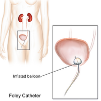 Foley Catheter Illustration