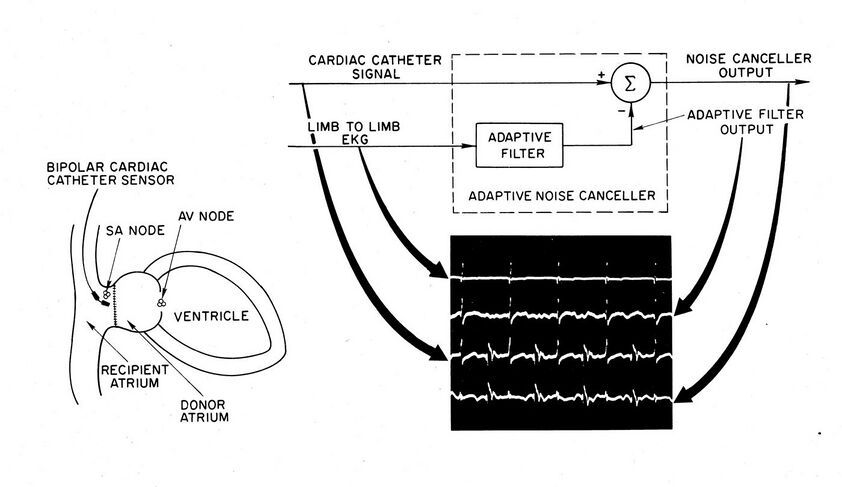Extracting Remnant Pacemaker Signal from Heart transplant ECG