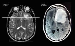 MRI Slices - 2007 and 2014 of astrocytoma patient - Steven Keating.jpg