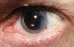 Photo of a left eye with widely dilated pupil. a small red spot on the lower distal side is all that can be seen of the incision.