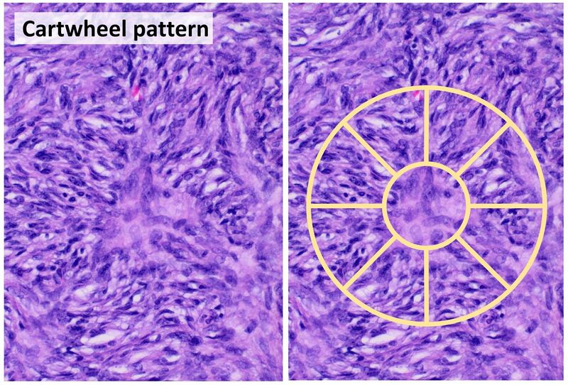 File:Histopathology of cartwheel pattern in dermatofibrosarcoma protuberans, annotated.jpg