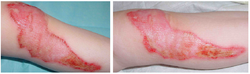 WIRA-Wiki-GH-009-Burn-wound-improvement-with-wIRA.png