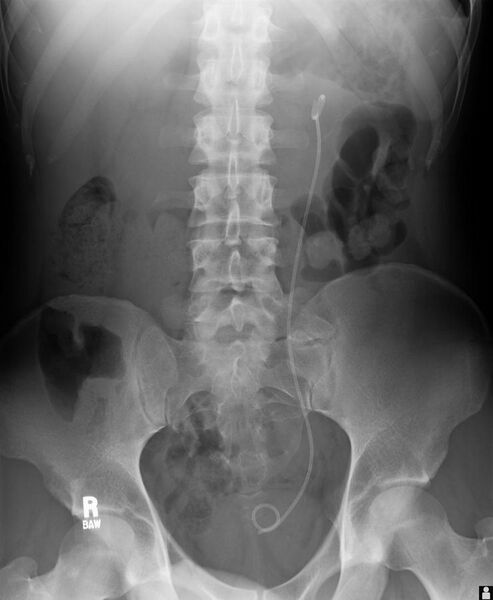 File:Abdominal Xray with uretal stent.jpg
