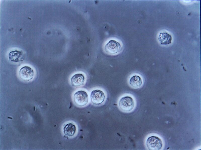 File:Bacteriuria pyuria 4.jpg