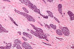 Desmoplastic small round cell tumour - intermed mag.jpg