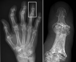 Erosive osteoarthritis with gull-wing appearance.jpg