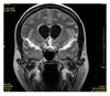 FLAIR MRI of meningitis.jpg
