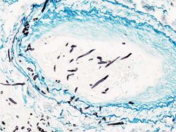 Pulmonary angioinvasive aspergillosis.jpg