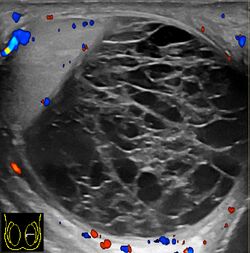 Scrotal Doppler ultrasonography of hematocele.jpg