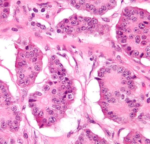 File:Small intestine neuroendocrine tumour high mag cropped.jpg