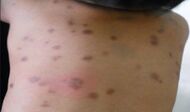 Urticaria pigmentosa lesions on a child.jpg
