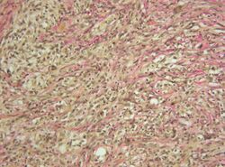 Gliosarcoma Histopathology 200x EVG.jpg