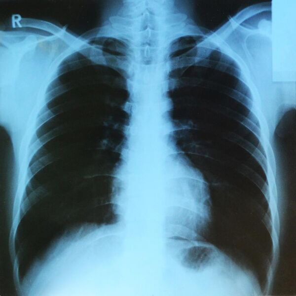 File:Lung X-ray.jpg