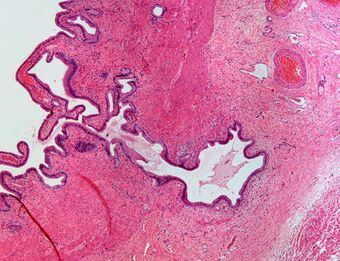 Rokitansky-Aschoff sinus in a case of chronic cholecystitis.JPG