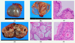 Squamous Ovarian Cell Carcinoma.png