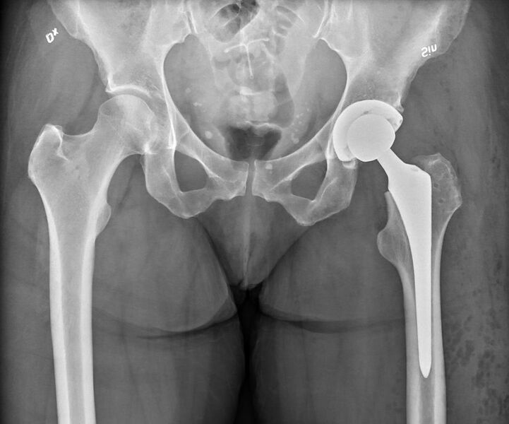 File:X-ray of pelvis with total arthroplasty.jpg