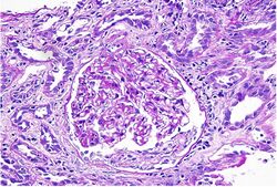 Acute Interstitial Nephritis.jpg