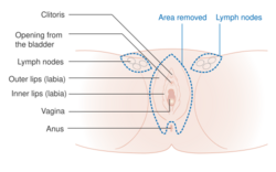 Diagram of a 3 in 1 incision vulvectomy CRUK 018.svg