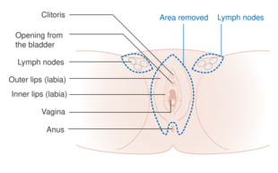 Diagram of a 3 in 1 incision vulvectomy CRUK 018.svg