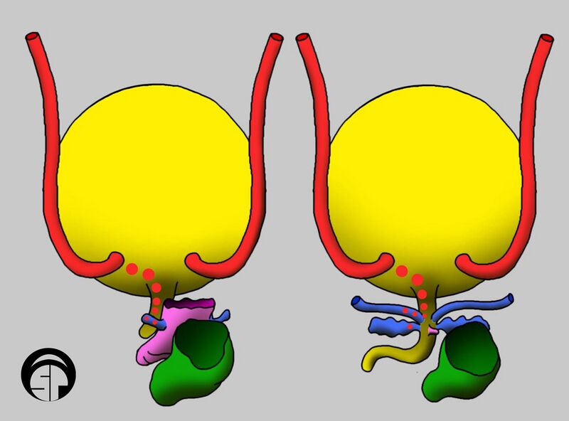 File:Ectopic Ureter Positions.jpg