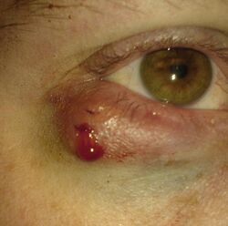 Chalazion (Excised) 02.jpg