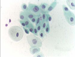 Pap test atropy.JPG