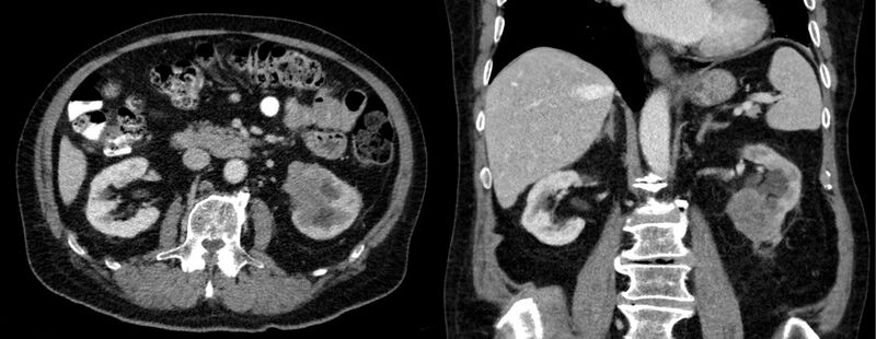 File:Bellini duct carcinoma 80jm - CT axial und coronar - 001.jpg