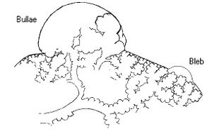 A schematic drawing showing a bulla and a bleb, two lung abnormalities that can lead to pneumothorax