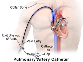 Pulmonary artery catheter