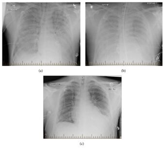 Radiographic progression of hantavirus pulmonary syndrome in patient.jpg