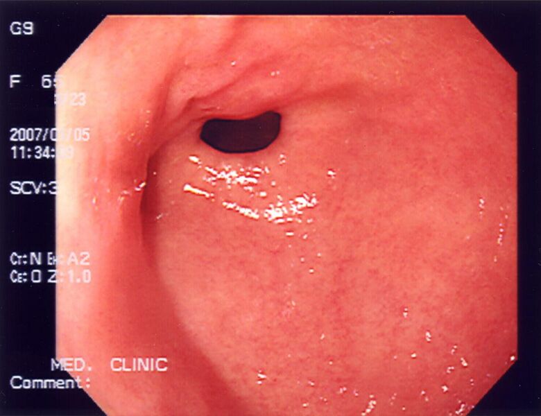 File:Stomach endoscopy 1.jpg