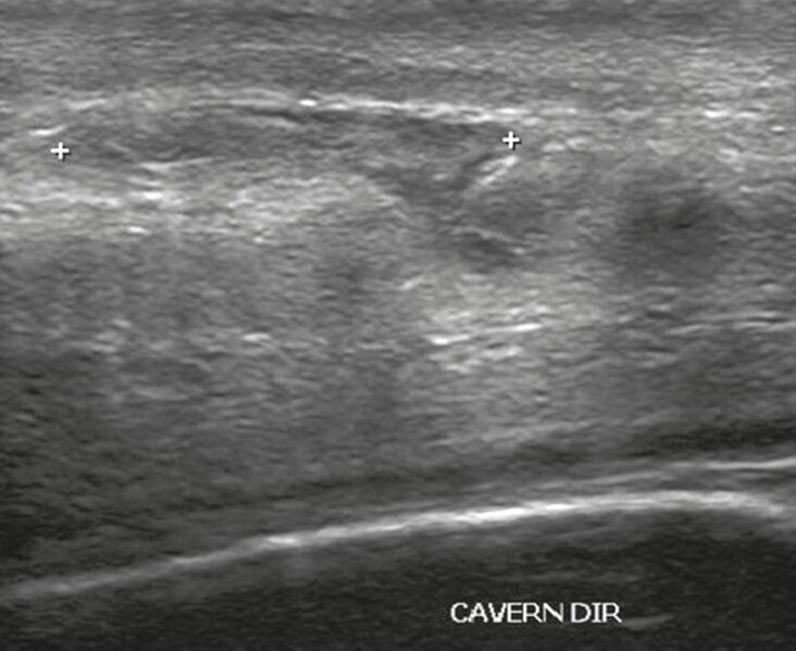 File:Ultrasonography of ruptured tunica albuginea.jpg