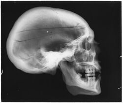 Photograph of an x-ray of a human skull