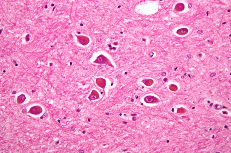 File:Alzheimer type II astrocyte high mag.jpg