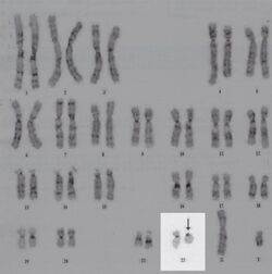 Karyotype-of-the-described-patient-The-arrow-indicates-the-ring-chromosome-22.jpg