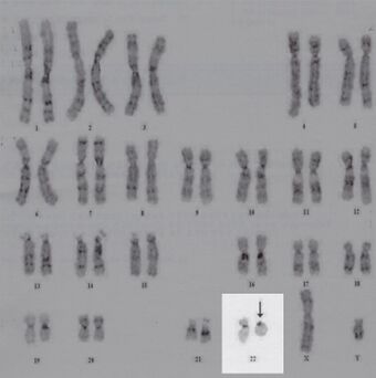 Karyotype-of-the-described-patient-The-arrow-indicates-the-ring-chromosome-22.jpg