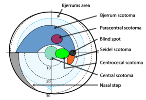 Graphic detailing the location on the visual field of Jannik Bjerrum's area, as well as several other types of scotomas - including the paracentral scotoma, the central scotoma, seidels scotoma, bjerrums scotoma and the centrocecal scotoma.