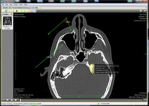 Ginkgo CADx displaying a CT.jpg