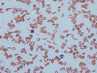 Sickle cells.jpg