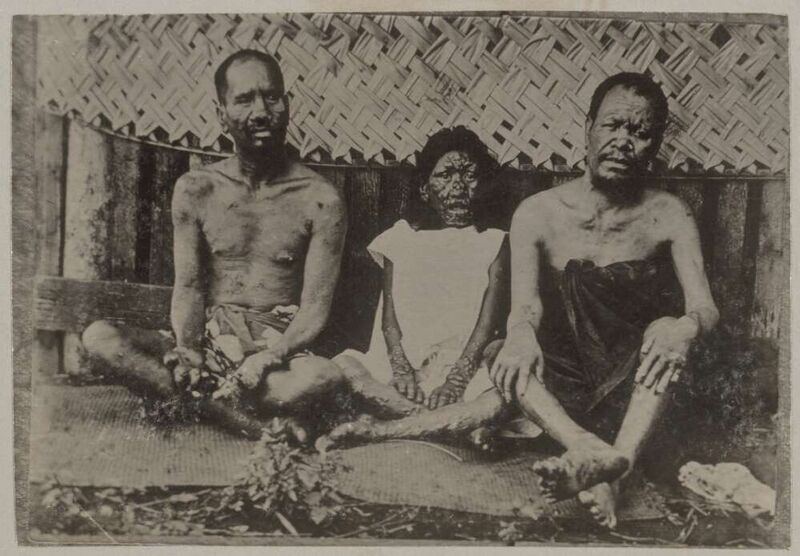 File:Three Tahitians suffering from leprosy, Tahiti, approximately 1895.jpg