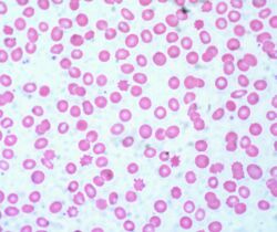 Acanthocytes, Peripheral Blood (3884092551).jpg