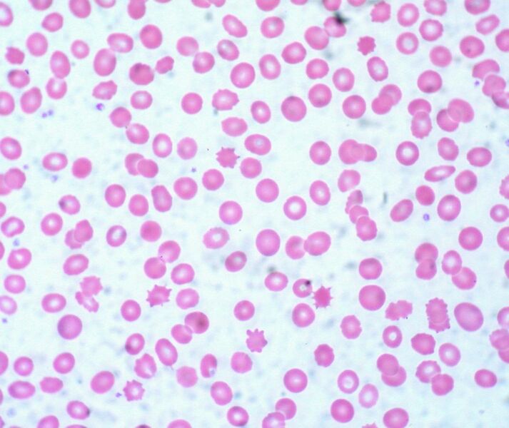 File:Acanthocytes, Peripheral Blood (3884092551).jpg