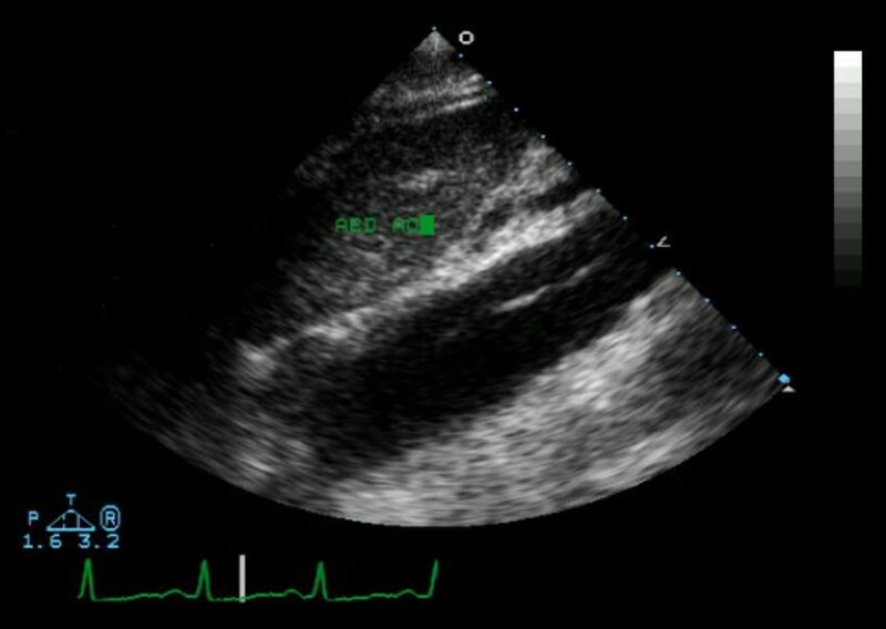 File:Aortic dissection - Echocardiogram - Longitudinal view.jpg