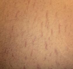 Belly Strech Marks.jpg