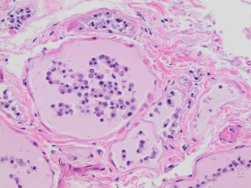 File:Histopathology of thyroid parenchyma with autolytic changes.jpg