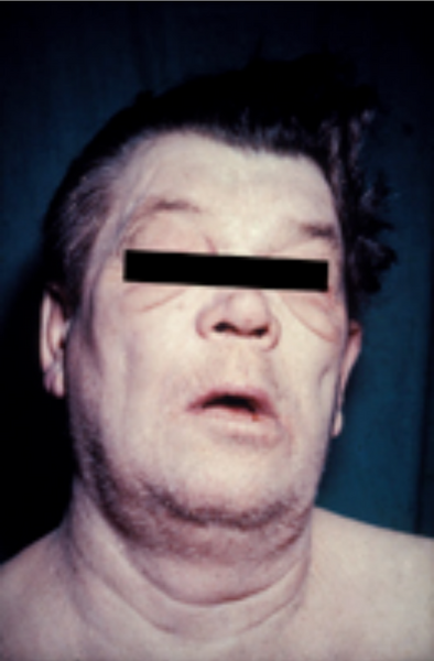 File:Myxedema face.png