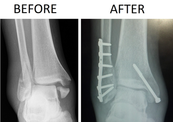 Trimalleolar Ankle Fracture Xray shown before surgery and after surgery.png