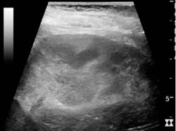 Ultrasonography of acute pyelonephritis.jpg