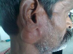 Parotid Tumour.jpg